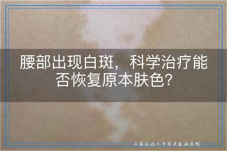 腰部出现白斑，科学治疗能否恢复原本肤色？