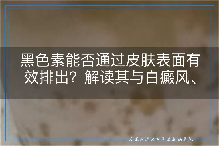 黑色素能否通过皮肤表面有效排出？解读其与白癜风、白斑的关联