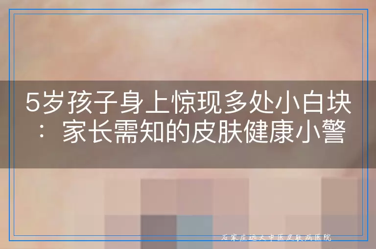 5岁孩子身上惊现多处小白块：家长需知的皮肤健康小警钟与日常护理指南