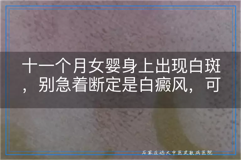 十一个月女婴身上出现白斑，别急着断定是白癜风，可能只是虚惊一场