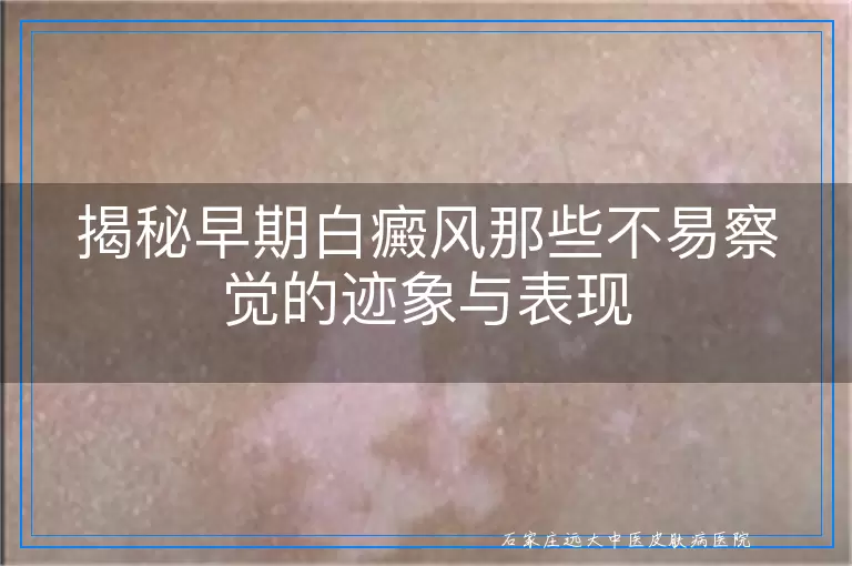 揭秘早期白癜风那些不易察觉的迹象与表现