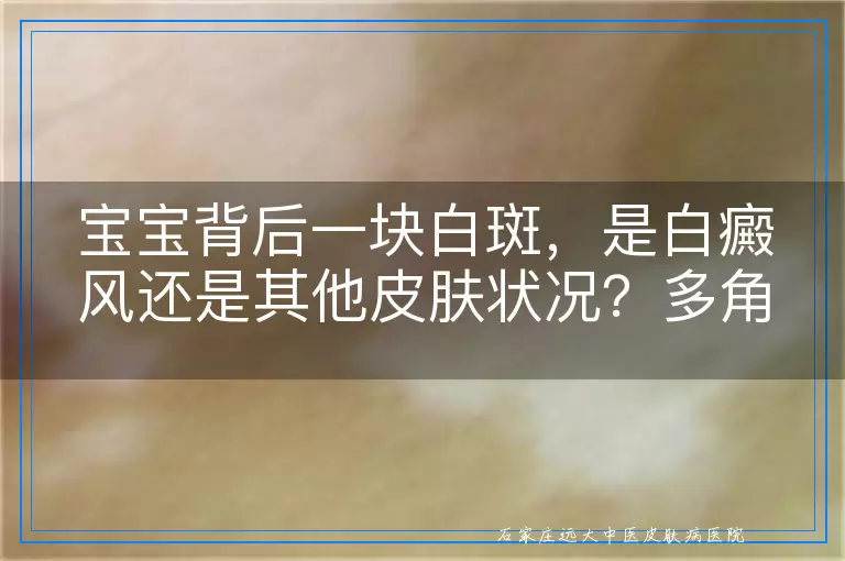 宝宝背后一块白斑，是白癜风还是其他皮肤状况？多角度解析与答疑