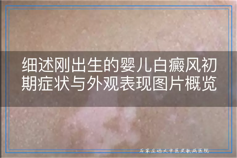 细述刚出生的婴儿白癜风初期症状与外观表现图片概览