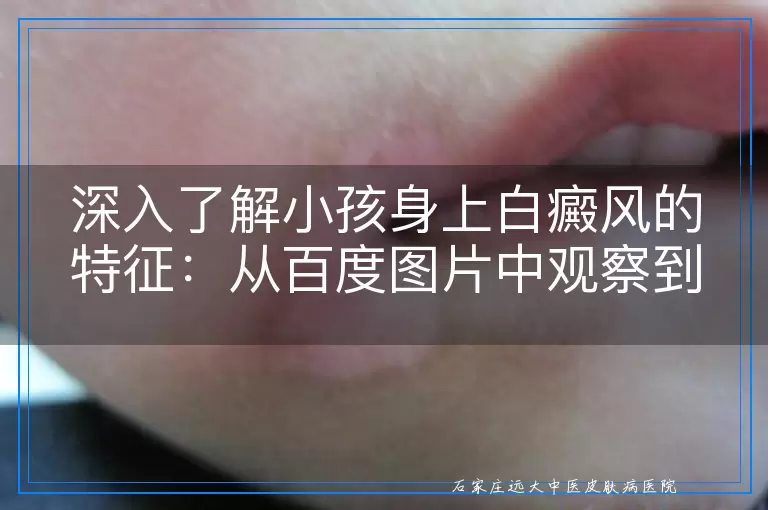 深入了解小孩身上白癜风的特征：从百度图片中观察到的细节与常识