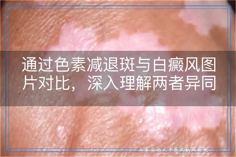 通过色素减退斑与白癜风图片对比，深入理解两者异同及影响