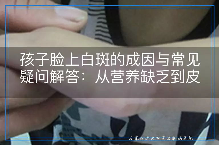 孩子脸上白斑的成因与常见疑问解答：从营养缺乏到皮肤状况的深度剖析