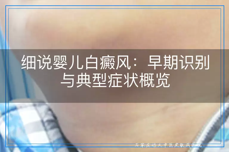 细说婴儿白癜风：早期识别与典型症状概览