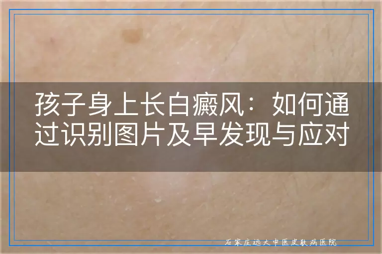 孩子身上长白癜风：如何通过识别图片及早发现与应对