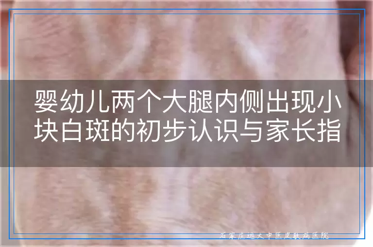 婴幼儿两个大腿内侧出现小块白斑的初步认识与家长指南