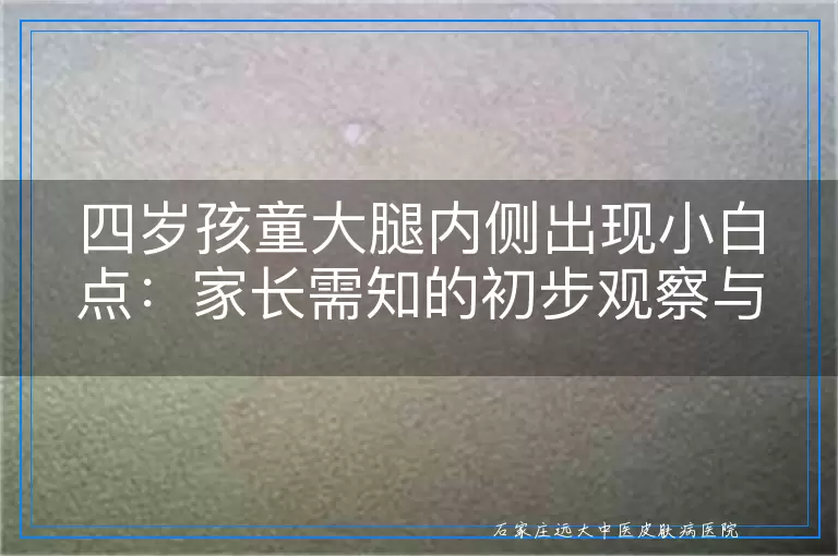 四岁孩童大腿内侧出现小白点：家长需知的初步观察与白癜风初步辨识