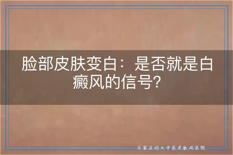 脸部皮肤变白：是否就是白癜风的信号？
