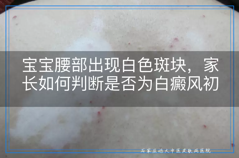 宝宝腰部出现白色斑块，家长如何判断是否为白癜风初期症状？