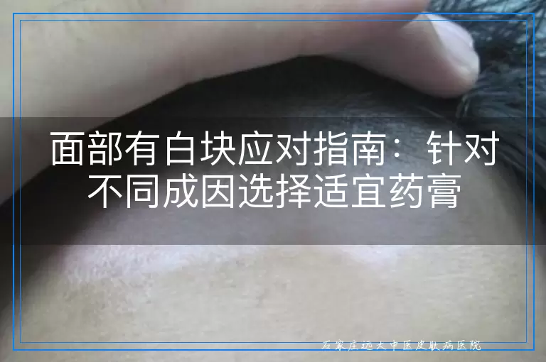 面部有白块应对指南：针对不同成因选择适宜药膏