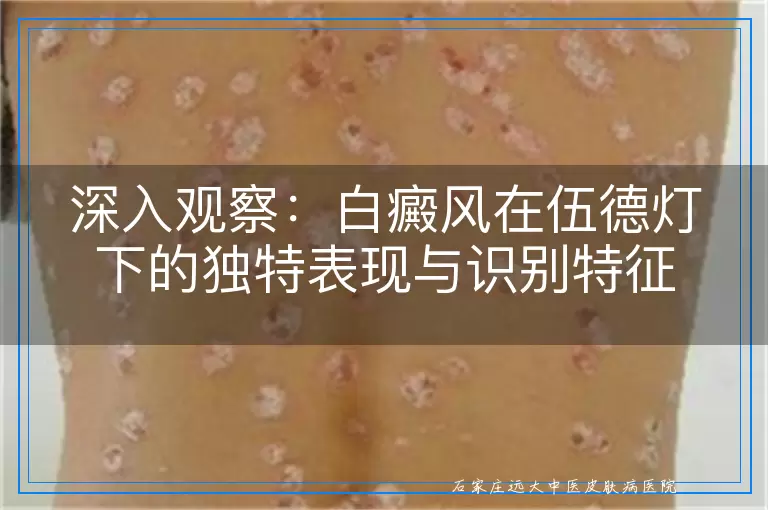 深入观察：白癜风在伍德灯下的独特表现与识别特征
