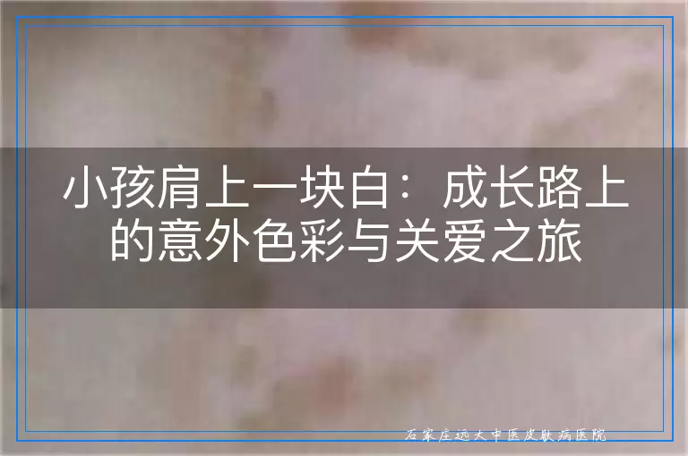 小孩肩上一块白：成长路上的意外色彩与关爱之旅