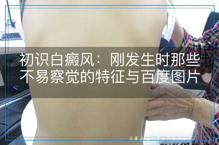 初识白癜风：刚发生时那些不易察觉的特征与百度图片搜索的启示