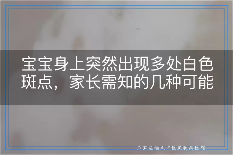 宝宝身上突然出现多处白色斑点，家长需知的几种可能原因与应对建议