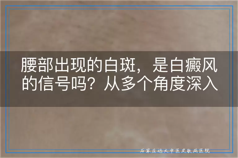 腰部出现的白斑，是白癜风的信号吗？从多个角度深入解读