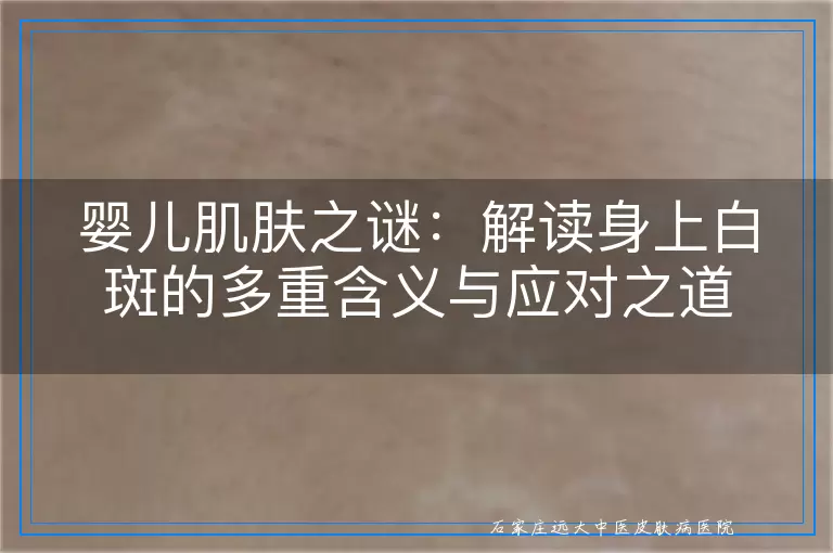 婴儿肌肤之谜：解读身上白斑的多重含义与应对之道