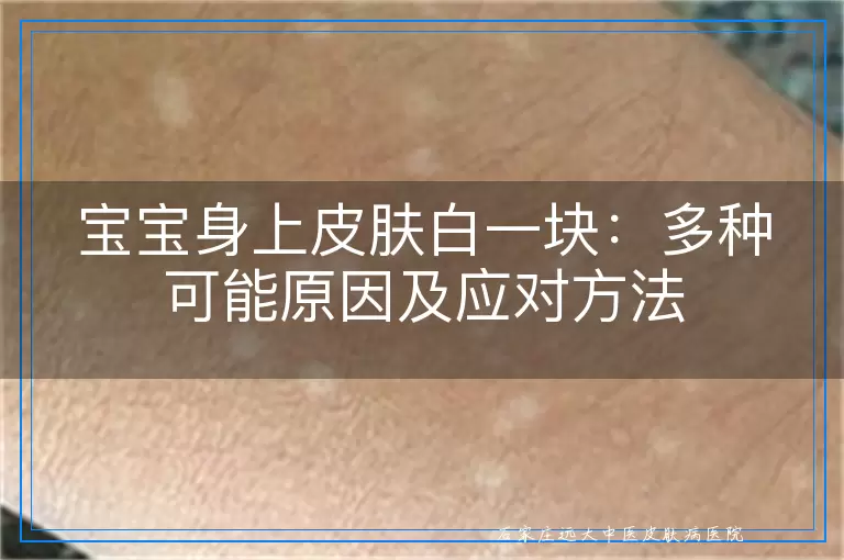 宝宝身上皮肤白一块：多种可能原因及应对方法