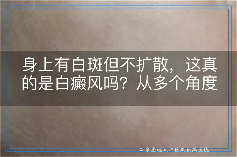 身上有白斑但不扩散，这真的是白癜风吗？从多个角度深入剖析