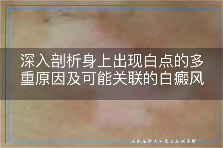 深入剖析身上出现白点的多重原因及可能关联的白癜风风险