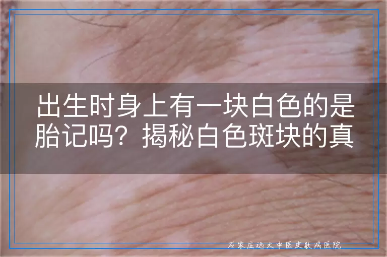 出生时身上有一块白色的是胎记吗？揭秘白色斑块的真实身份与胎记的区别