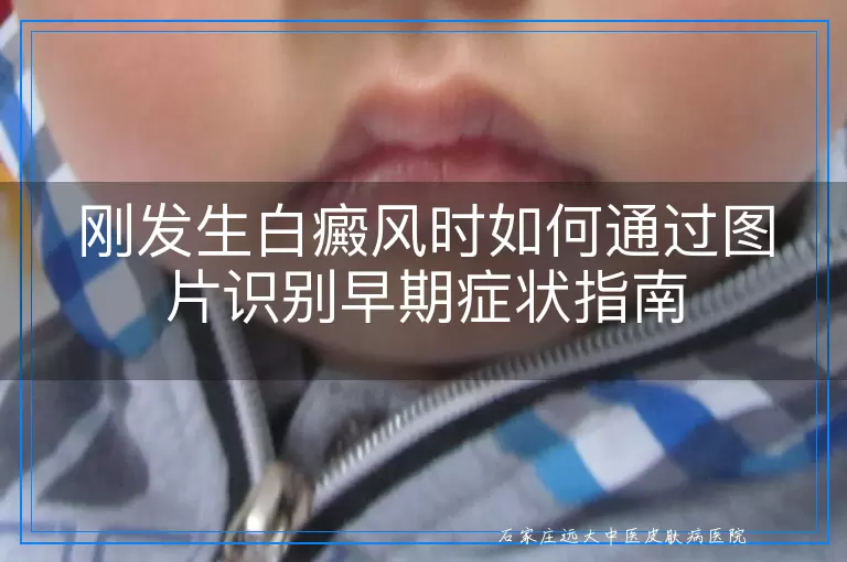 刚发生白癜风时如何通过图片识别早期症状指南