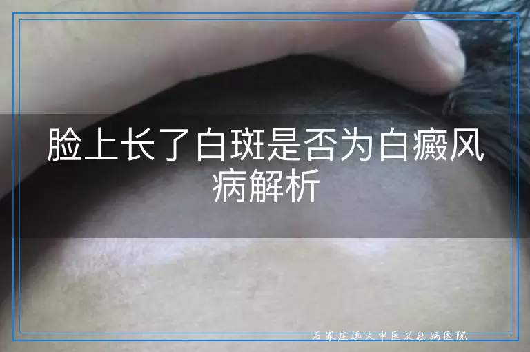 脸上长了白斑是否为白癜风病解析