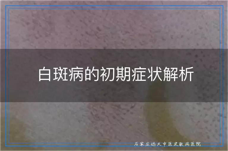 白斑病的初期症状解析