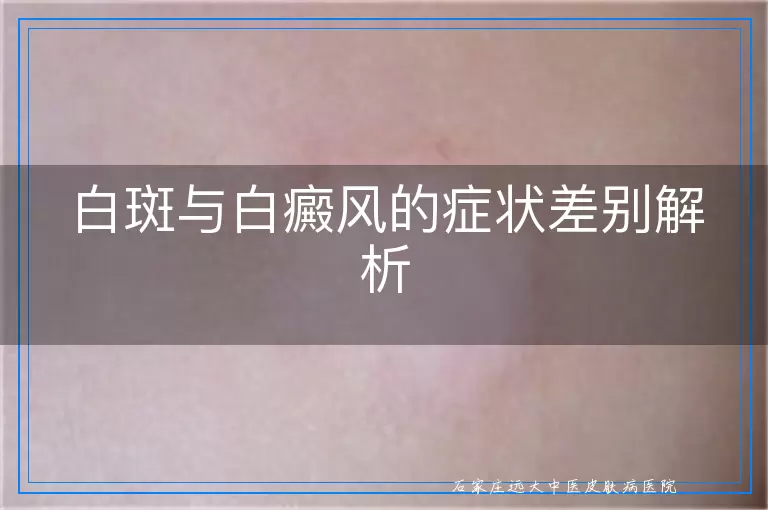 白斑与白癜风的症状差别解析
