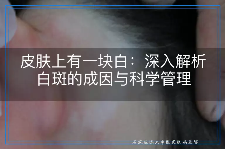 皮肤上有一块白：深入解析白斑的成因与科学管理