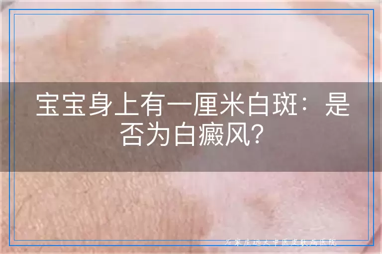宝宝身上有一厘米白斑：是否为白癜风？