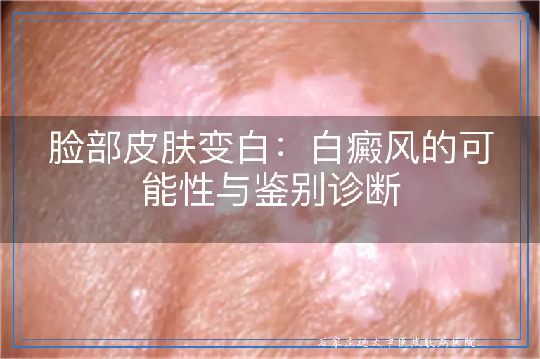 脸部皮肤变白：白癜风的可能性与鉴别诊断