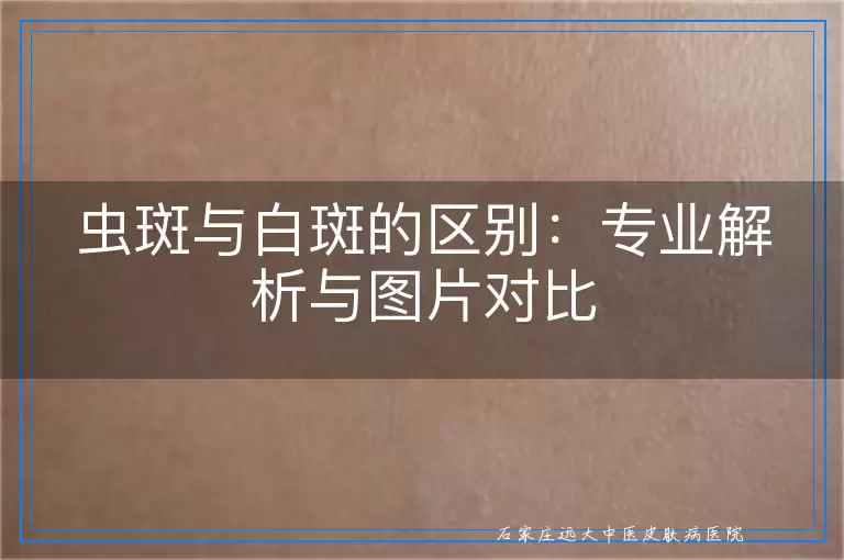 虫斑与白斑的区别：专业解析与图片对比