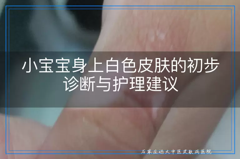 小宝宝身上白色皮肤的初步诊断与护理建议