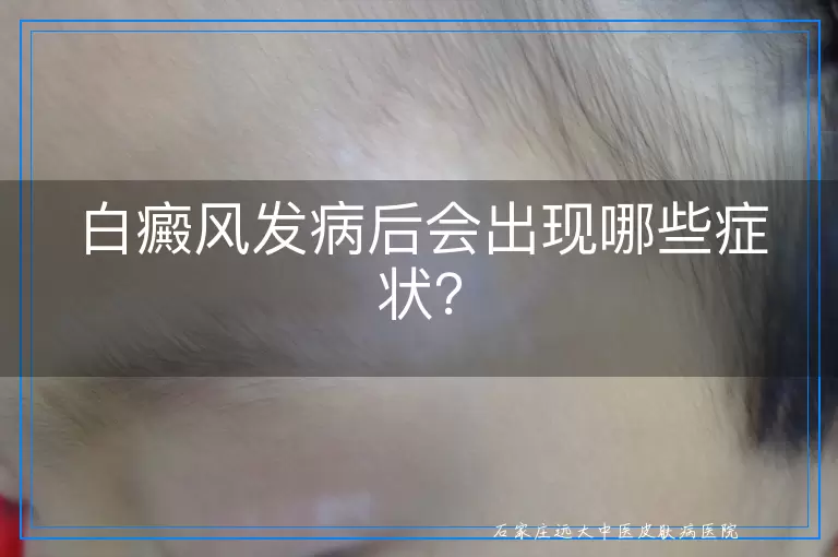 白癜风发病后会出现哪些症状？