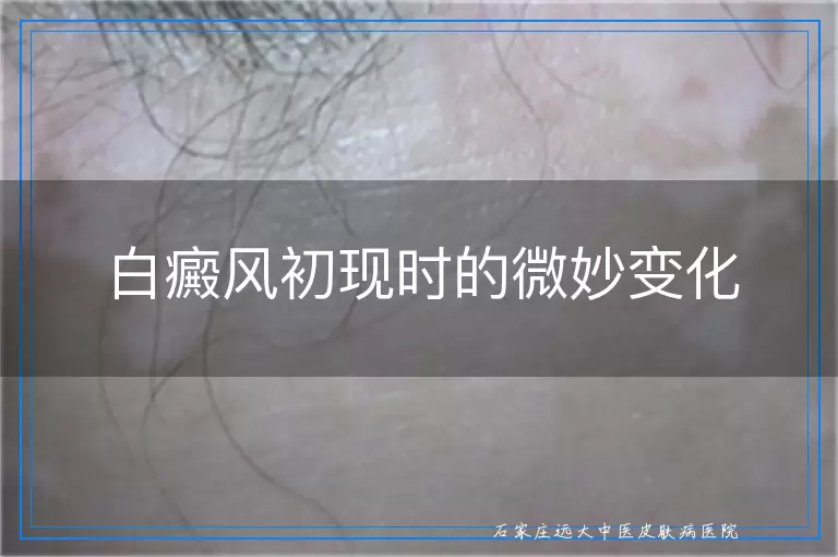 白癜风初现时的微妙变化