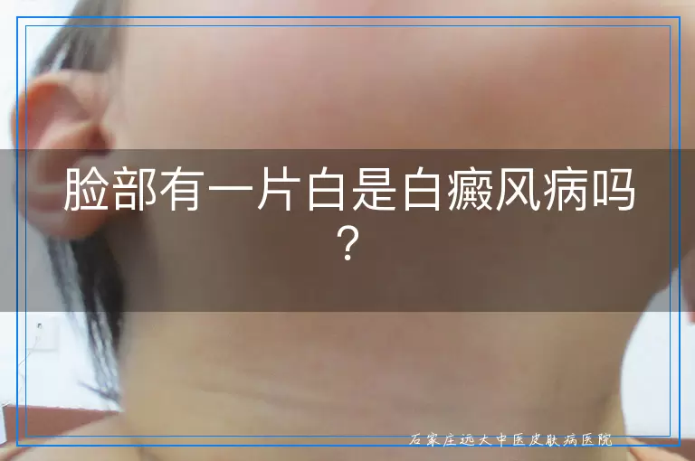 脸部有一片白是白癜风病吗？