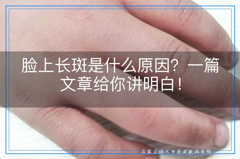 脸上长斑是什么原因？一篇文章给你讲明白！