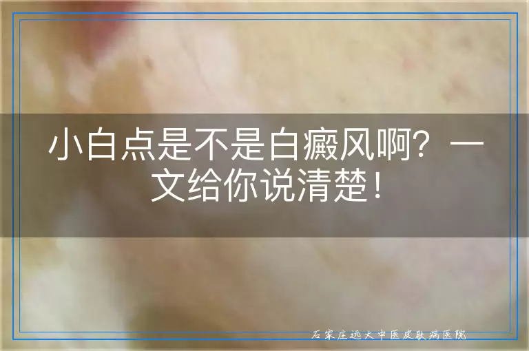 小白点是不是白癜风啊？一文给你说清楚！