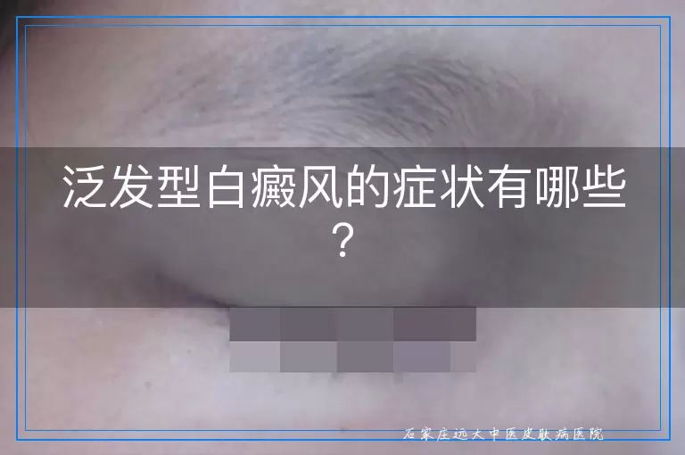 泛发型白癜风的症状有哪些？