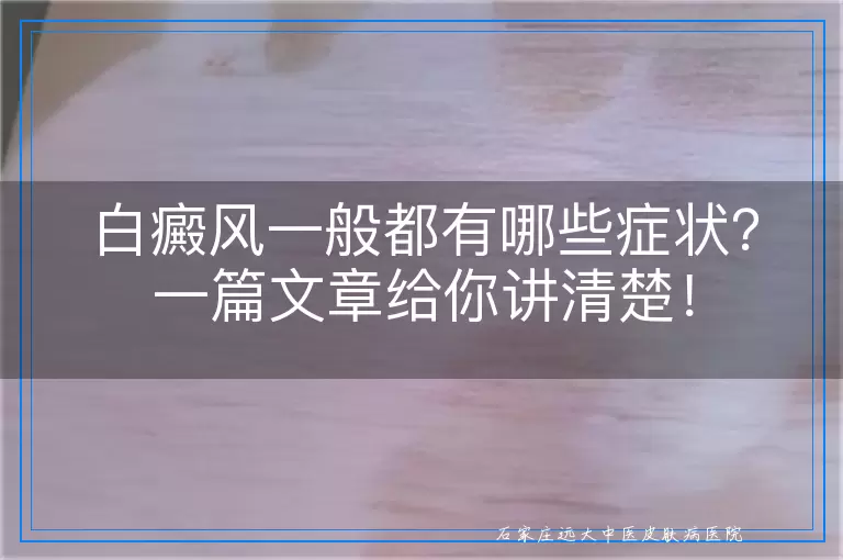 白癜风一般都有哪些症状？一篇文章给你讲清楚！