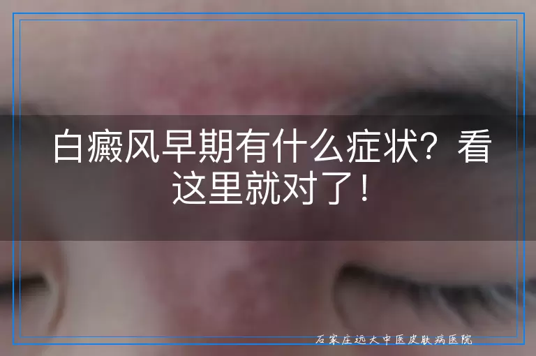 白癜风早期有什么症状？看这里就对了！