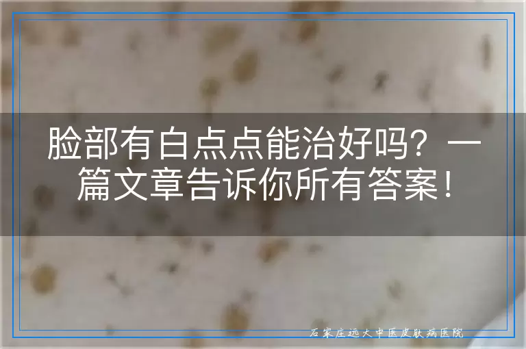脸部有白点点能治好吗？一篇文章告诉你所有答案！