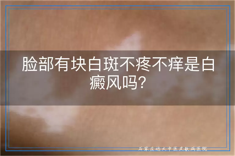 脸部有块白斑不疼不痒是白癜风吗？