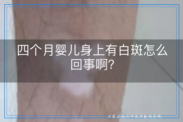四个月婴儿身上有白斑怎么回事啊？
