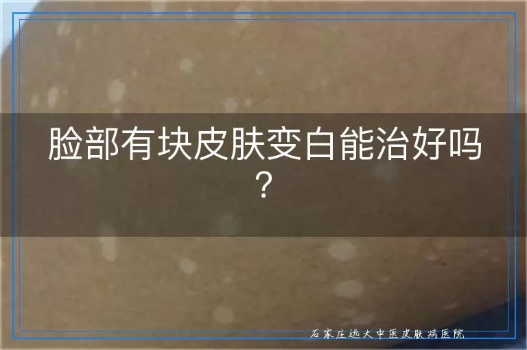 脸部有块皮肤变白能治好吗？