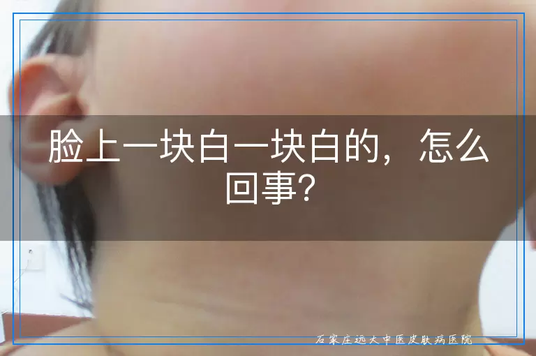 脸上一块白一块白的，怎么回事？