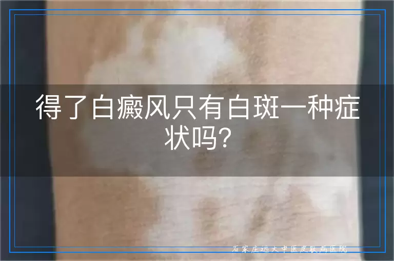 得了白癜风只有白斑一种症状吗？